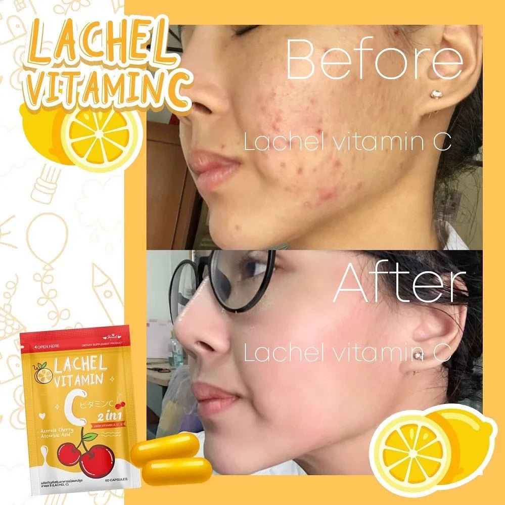 Lachel Vitamin C Bundle (2 Packets) | Radiant Skin , Immunity & Beauty